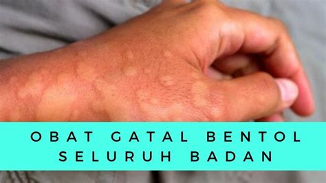 Gatal Bentol Pada Anak - balustradellc