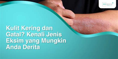 Gatal Eksim Kering - balustradellc