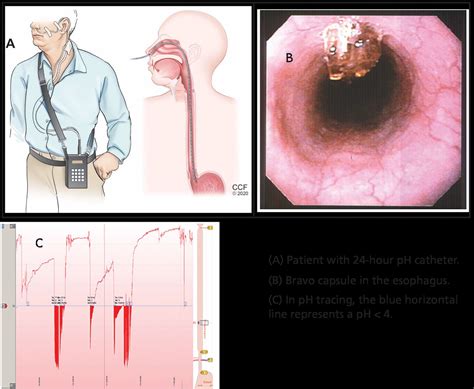 GERD TEST