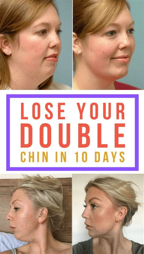 Get rid of a double chin in a week @eqqualberry_global ... - balustradellc