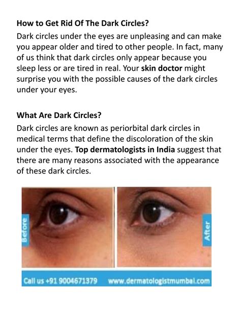 Get Rid of Dark Circles Permanently: Causes - balustradellc