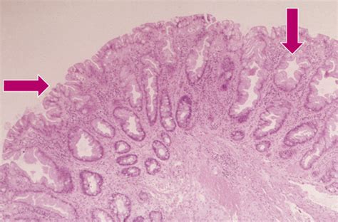 GI - Tumors of Small Intestine Flashcards Quizlet