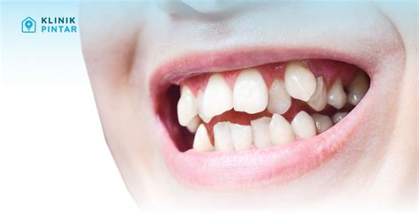 Gigi Tumbuh Tidak Rapi Kapan Perlu Konsultasi Ortodonti - balustradellc