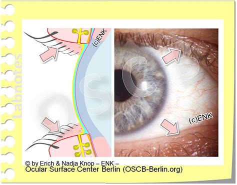 GLIMPSE on the LID MARGIN — Ocular Surface …