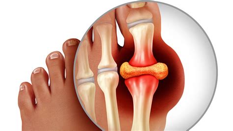 Gout - Diagnosis and treatment - Mayo Clinic - raincitystudios.com