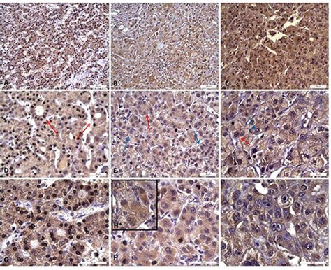 GPX4 and GPX7 over-expression in human hepatocellular