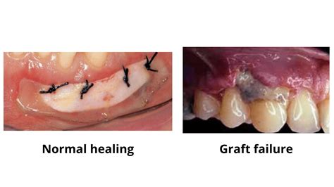 Graft | Description, Types, & Uses | Britannica - raincitystudios.com