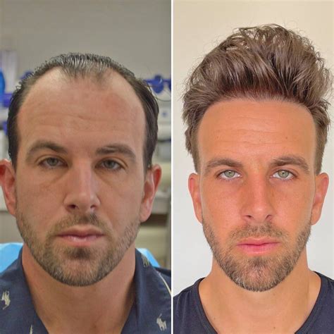 GREAT HAIR TRANSPLANT - 383 Photos & 20 Reviews