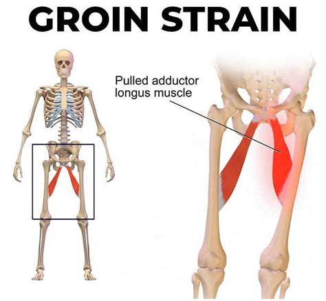 Groin Strain - Klinik Utama Eminence - balustradellc