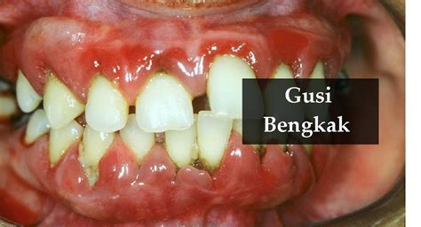 Gusi Bengkak Bernanah - Penyebab dan Cara Mengobati - balustradellc