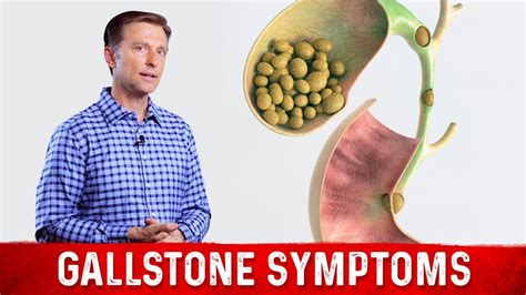 Gallbladder Attack is Commonly Due to Gallstones - Dr. Steven Williams