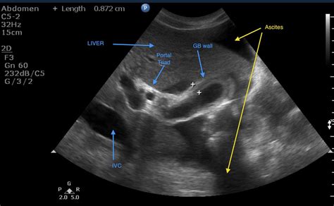 Gallbladder ultrasound. Things To Know About Gallbladder ultrasound. 