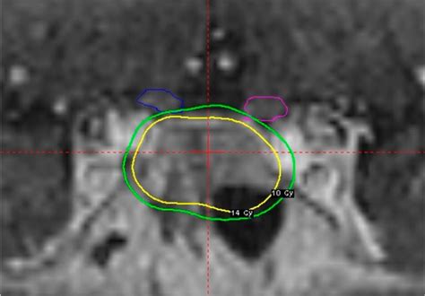 Gamma Knife milestone highlights expertise and …