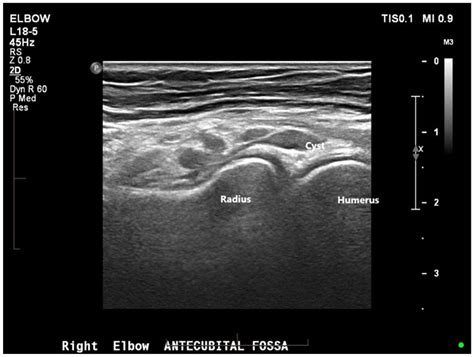 Ganglion Cyst of Radiocapitellar Joint Mimicking Lateral Epi ... - LWW