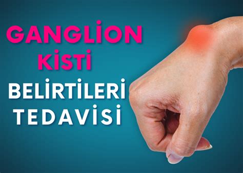 Ganglion Kisti Belirtileri Ganglion kisti genellikle şişlik şeklinde görülür ve büyüklüğü değişir.