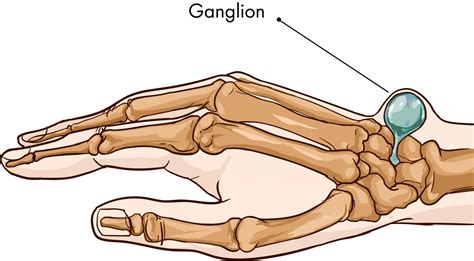 Ganglion cyst - Wikipedia