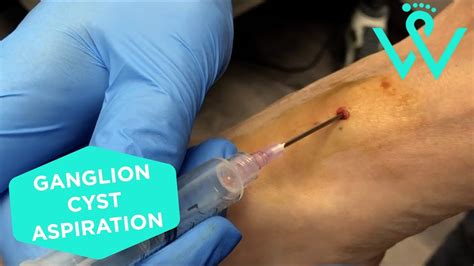 Apr 5, 2023 · Answer: You’ll need three CPT® codes, two diagnosis codes, and two modifiers to make this claim fly. On your claim, report: 20612 (Aspiration and/or injection of ganglion cyst (s) any location) for the first injection. M67.431 (Ganglion, right wrist) appended to 20612 to represent the patient’s wrist cyst. . 