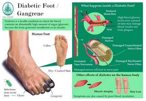 Gangrene right foot icd 10. The ICD code I739 is used to code Gangrene. Gangrene (or gangrenous necrosis) is a type of necrosis caused by a critically insufficient blood supply. This potentially life-threatening … 