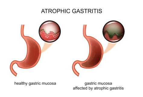 Gastrik atrofi nedir