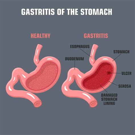 Gastritis – The inflammation of the stomach lining Vitalis Health ...