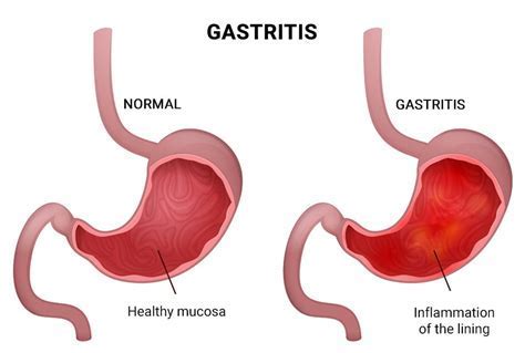 Gastritis not going away. .  ...