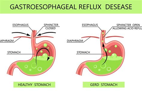 Gastro-oesophageal reflux disease The BMJ