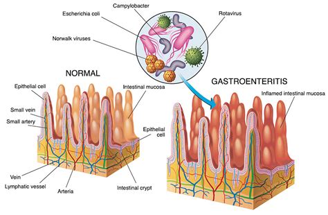 Gastroenteritis how is it spread