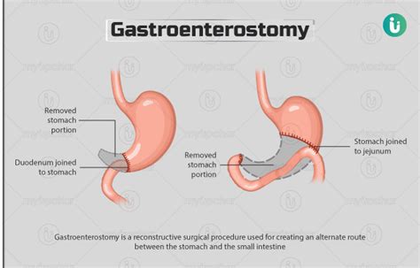 Gastroenterostomi