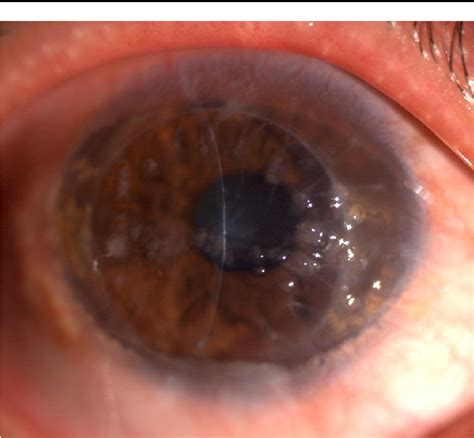 Gelatinous drop-like corneal dystrophy: for professionals