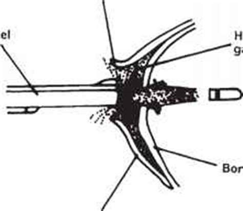 General wound ballistic concepts - Bev Fitchett