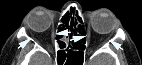 Genetic Extraocular Myopathies - fingertips.neuro …