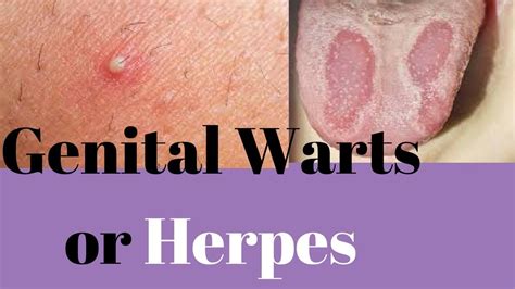 Genital herpes in women images. Genital herpes is very common; in fact, over 18 million people in the US have genital herpes. Many people don’t even know they have genital herpes - how is t... 