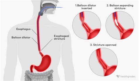 Gerd dilation procedures.  A balloon is expanded inside the esophagus t...