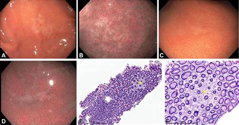 Germline mutations in hereditary diffuse gastric cancer