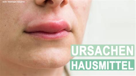 Geschwollene lippe allergie hausmittel