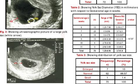 Gestational sac measurement chart. between 4+3 and 5+6 weeks – measure mean sac diameter (MSD) of gestational sac but do not date or assign EDD. between 6+0 and 9+6 weeks – crown rump length (CRL) [5.0 – 31.9mm] between 10+0 and 13+6 weeks - CRL (32.0mm – 80.0mm) between 14+0 and 24+0 weeks – HC and/or FL, both should ‘agree’. after 24+0 weeks, assess size not ... 