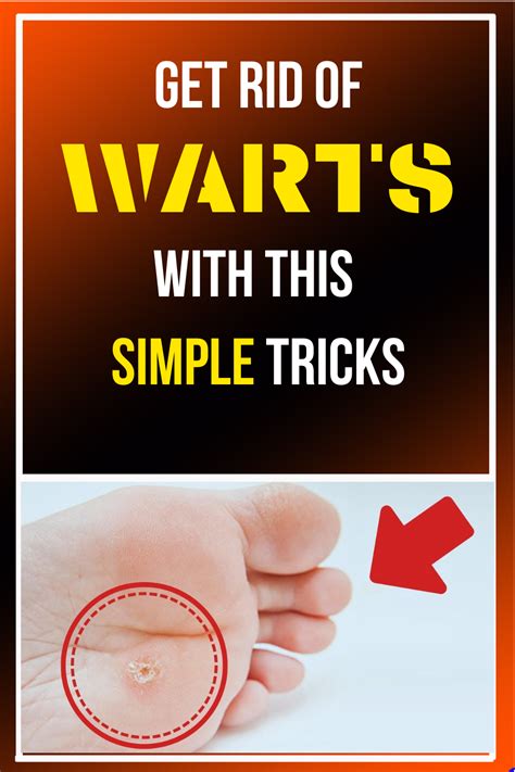 Get rid of warts the ultimate guide to getting rid of warts. - Vers in der neueren deutschen dichtung..