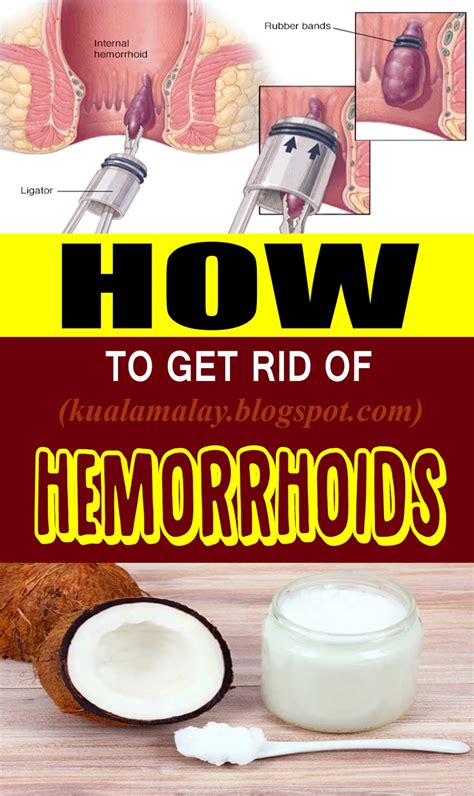 Getting Rid Of Hemorrhoids With Sugar