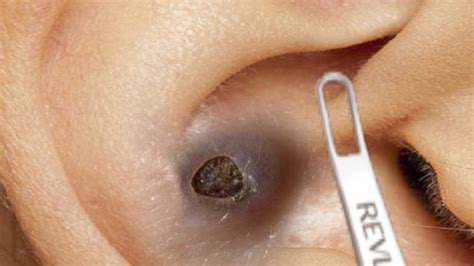 Aug 4, 2017 · In an eight-minute-and-39-second video recently posted by a spa in China, you can watch the blackheads being slowly but surely yanked out of the person's ear with a pair of pointed-tipped tweezers ... . 