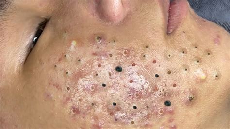Giant blackheads on the face part 4. Dr. Shah explains that blackheads, the common variety that develop on faces, are caused by blocked hair follicles. The keratin and sebum become oxidized to appear black. Umboliths, on the other ... 