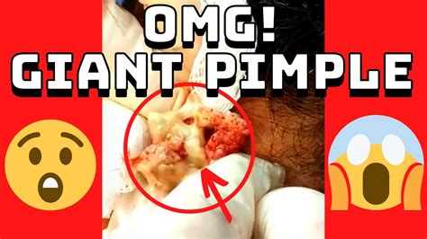 Attention all my popaholics out there. Here, watch as a person has a "dilated pore of winer" plucked from inside their ear.. 