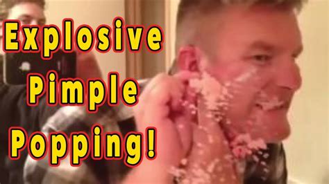 Giant pimple pops. *THIS VIDEO FALLS UNDER THE FAIR USE OF COPYRIGHT FOR LEARNING PURPOSES AS ALLOWED BY US COPYRIGHT LAW* I am trying to educate people in MEDICINE ...-----... 