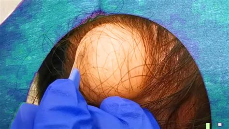 Giant popping spewing cyst on back. Cystic acne can look like large, pus-filled boils on the skin. It can also ... You should never try to squeeze or pop a cyst or pseudocyst yourself, as this can ... 