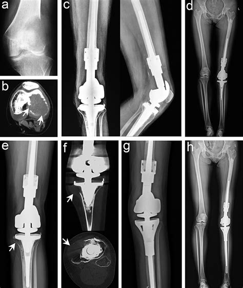 Giant-cell tumor of bone: treatment options and role of …