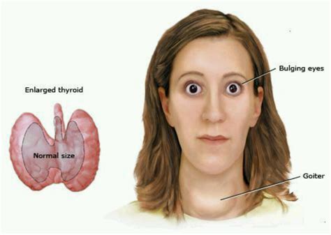 Giftstruma behandling