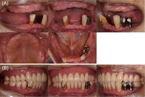 Gingival enlargement improvement following medication …