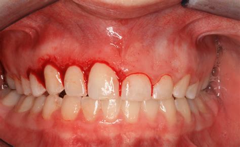 Normally when a disease causes deep pockets of plaque and calculus in your tooth, doctors recommend <b>Gingivectomy</b> surgery. . Gingivectomy