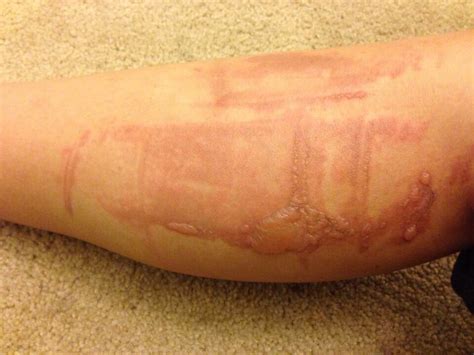 Ginny burn scars pictures. Things To Know About Ginny burn scars pictures. 