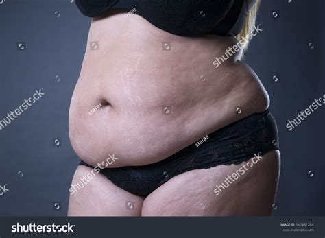 Girls sexy stretch marks belly.  Fat female belly, stretch marks closeup, on gray background.  ...