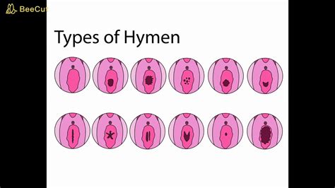 Girls virgin broken.  DW explains how hymens come in different shapes and why it's Los...